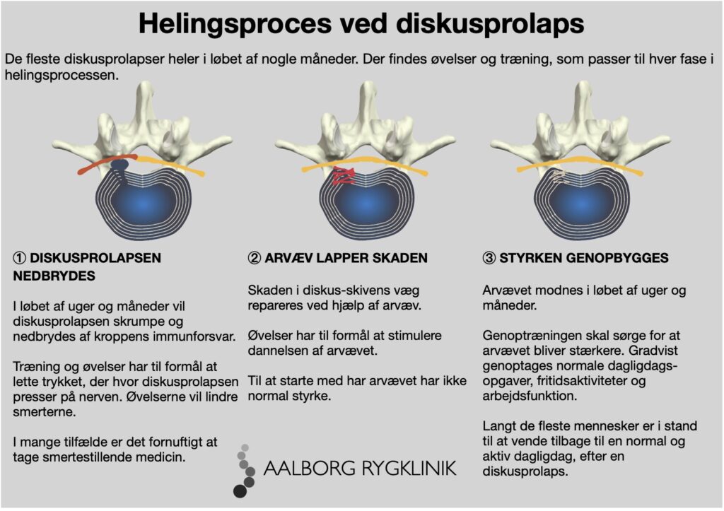 Diskusprolaps behandling