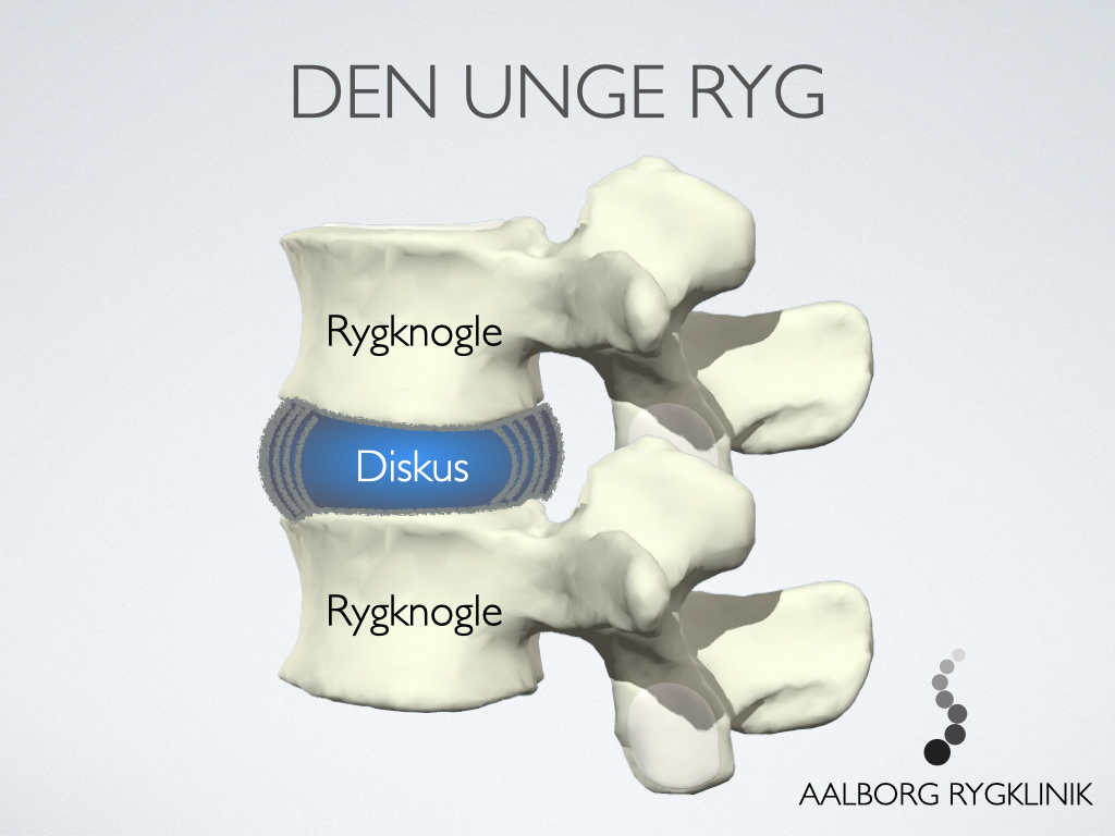 Forebyggelse af diskusprolaps