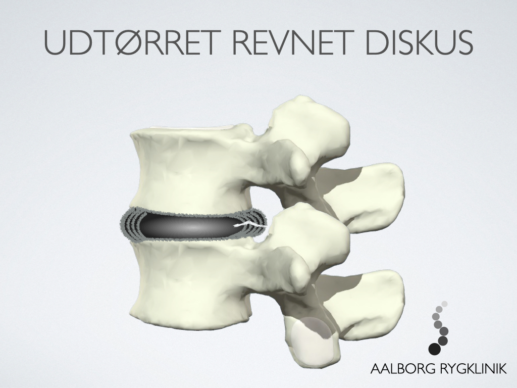 Revne i diskus