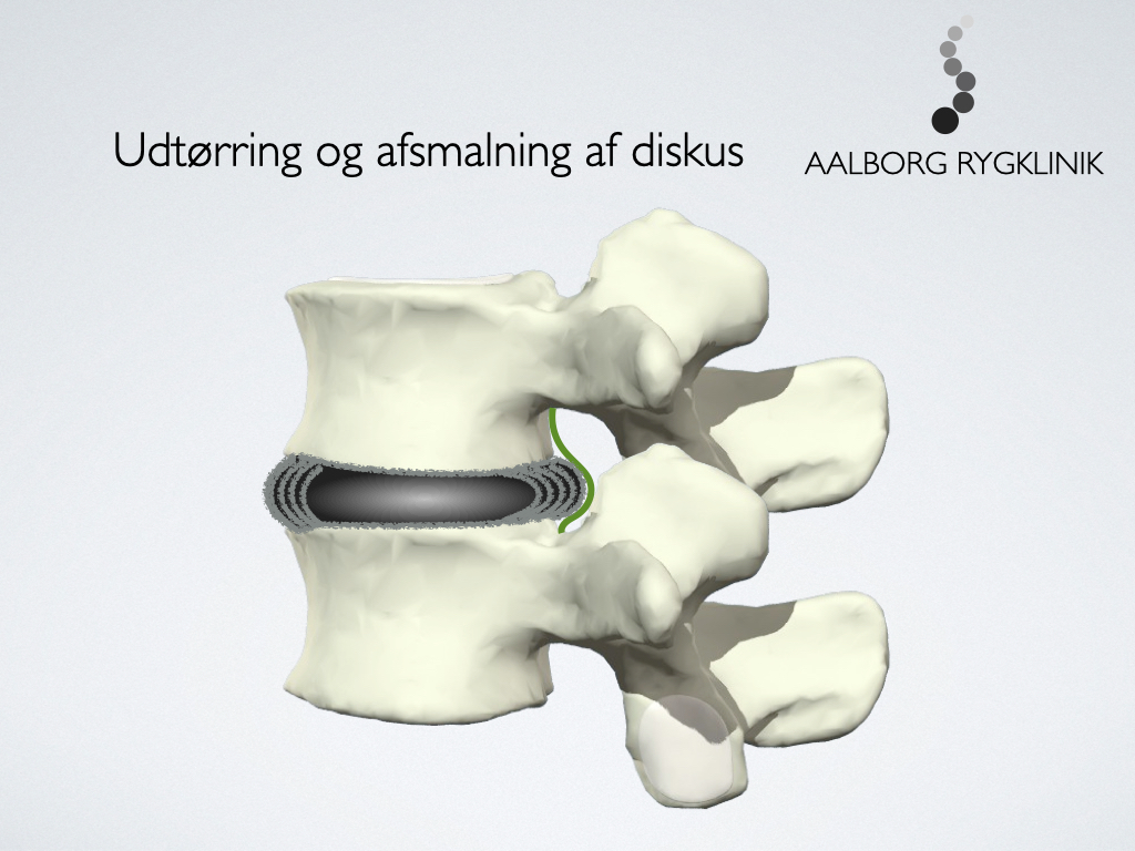 Udposning på diskus forsnævrer rygmarvskanalen