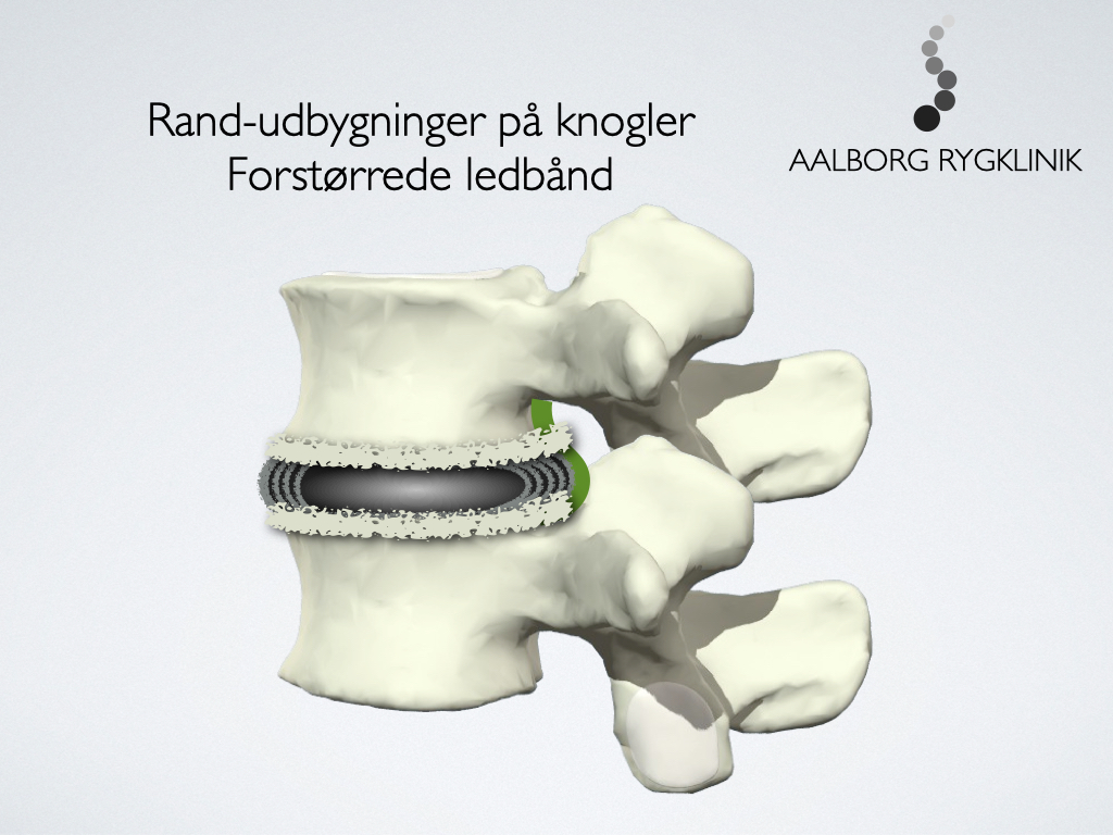 Randudbygninger (osteofytter)