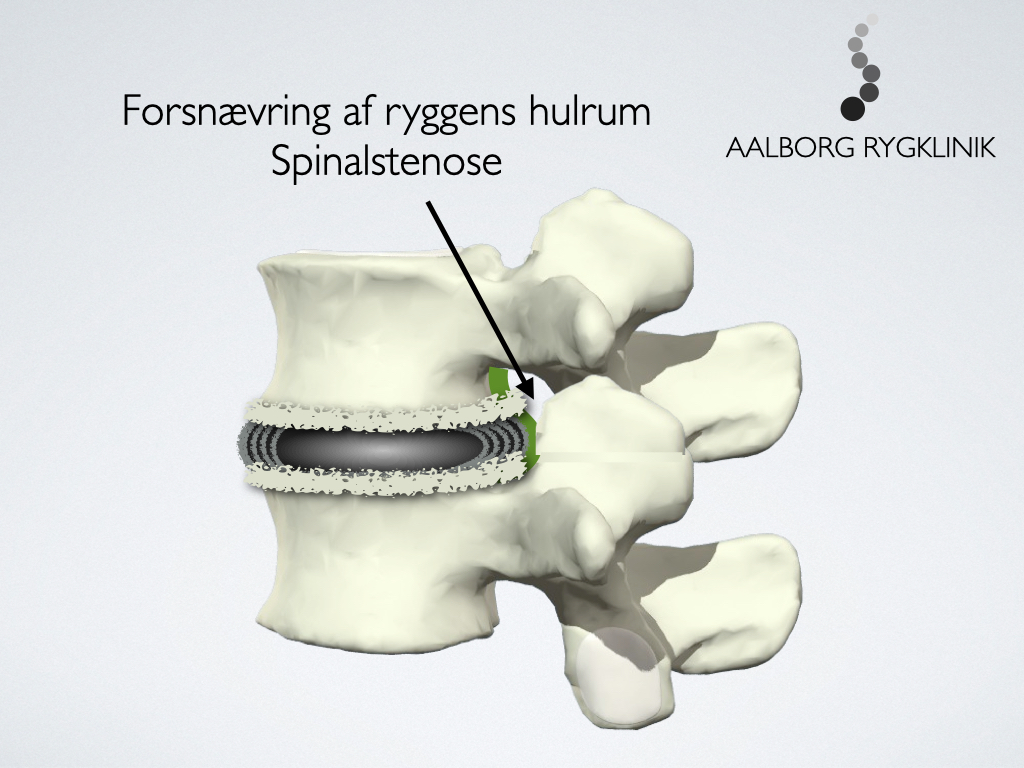 Hvad er spinalstenose?