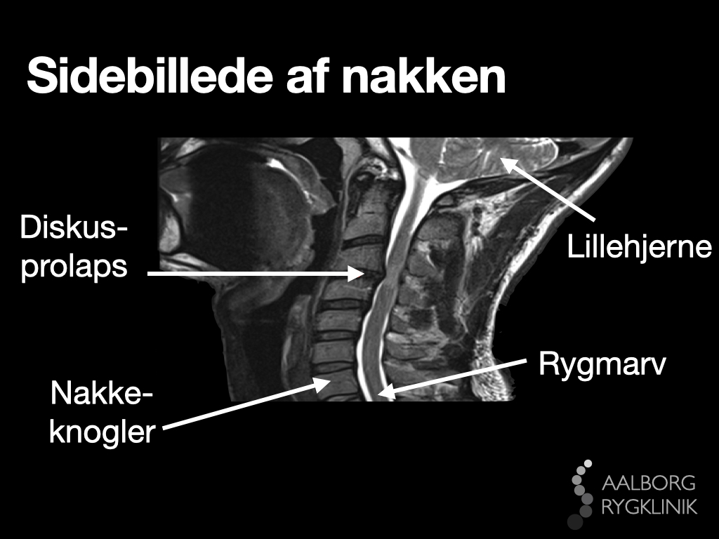 Diskusprolaps i nakken