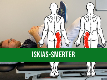 Iskias-smerter