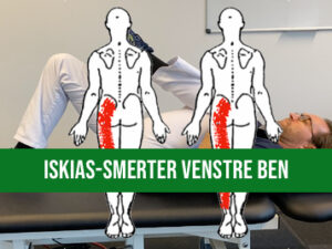 Iskias-smerter i venstre ben - smertelindrende øvelsesprogram